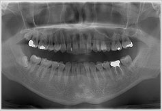 dental-implants img 02
